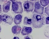 Etude prospective pour la BCG thérapie dans les tumeurs de vessie n'infiltrant pas le muscle chez les patients porteurs de VIH