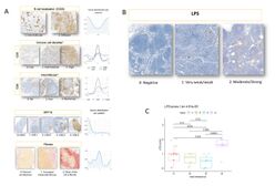 Étude des mécanismes immunosuppresseurs dans le cancer primitif du foie