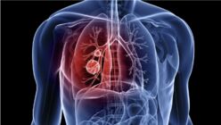 Développement d’une approche d’immunothérapie active du cancer du poumon non à petites cellules (NSCLC) par une approche de thérapie cellulaire.