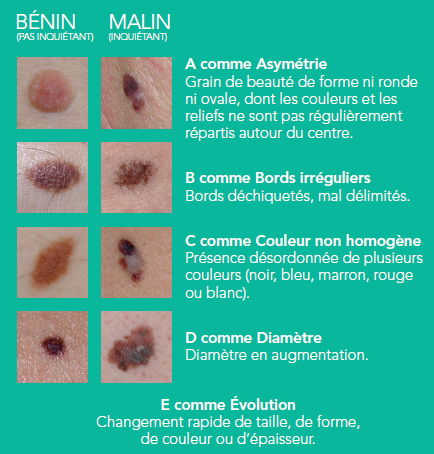Règle ABCDE